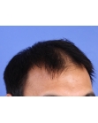 Before Hair Transplant&nbsp;2 Sessions (Areas)